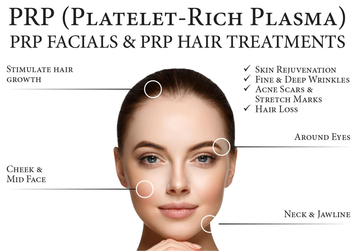 PRP (platelet rich plasma) single seession