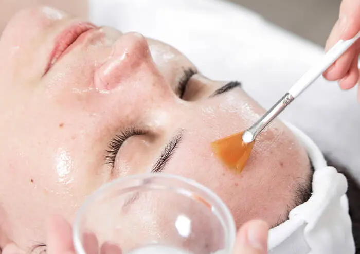 Chemical peel