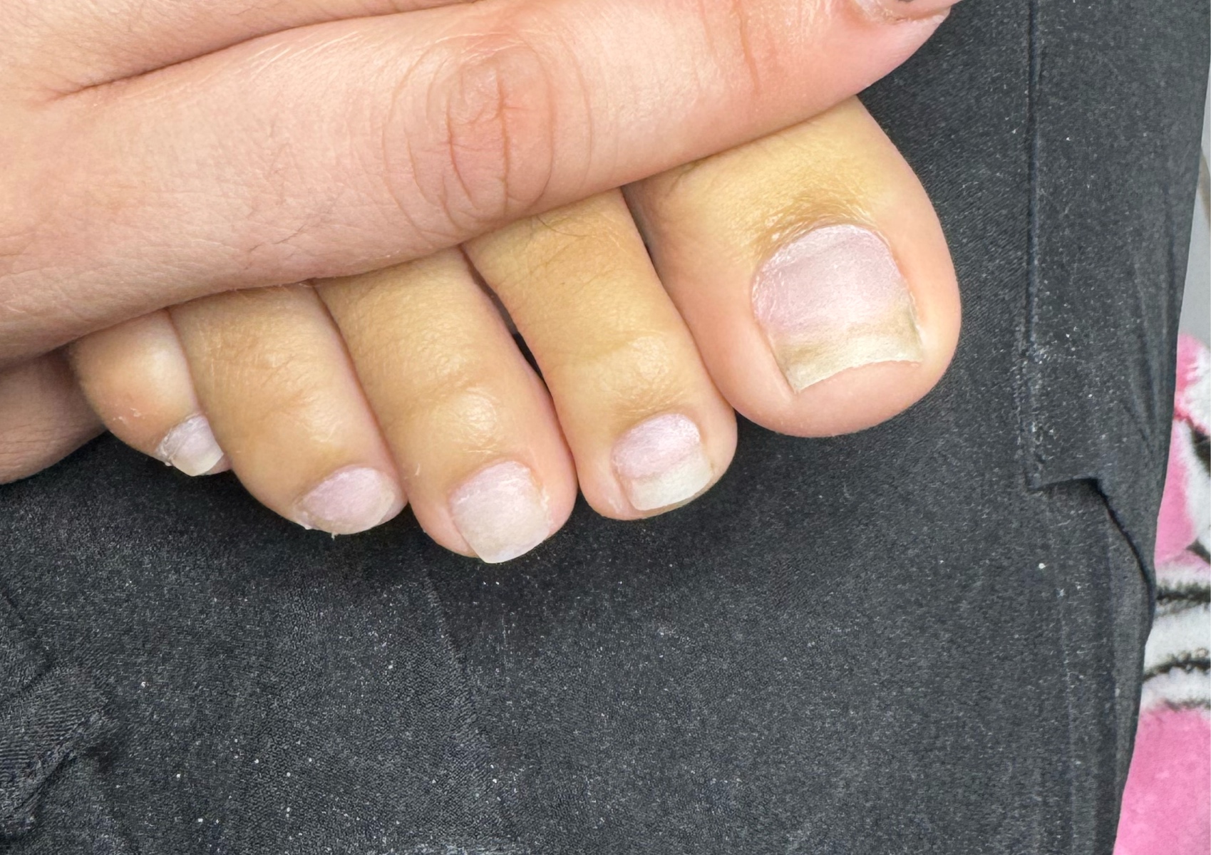 Remoción y Aplicación de Gel