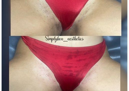 Bikini Line *ladies only