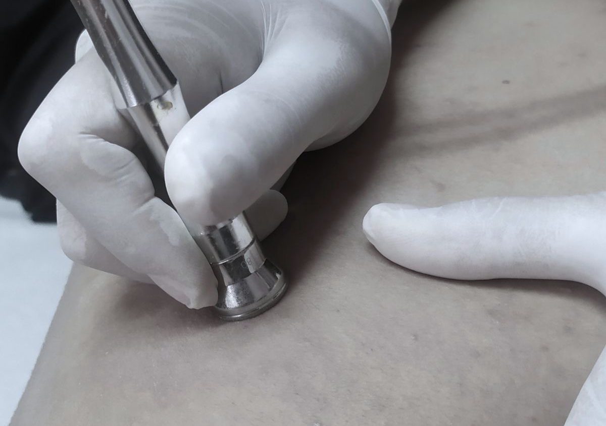 (5) sesiones de limpieza de espalda 