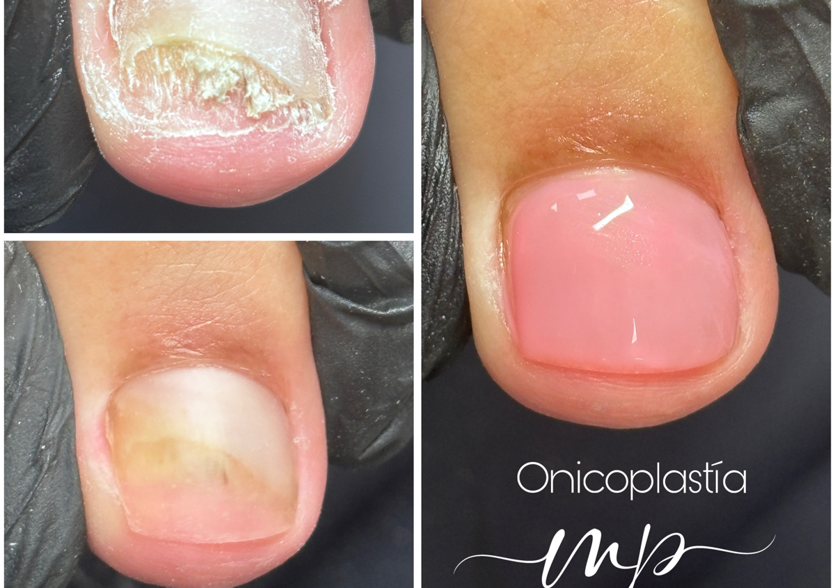 Onicoplastía Dos Uñas