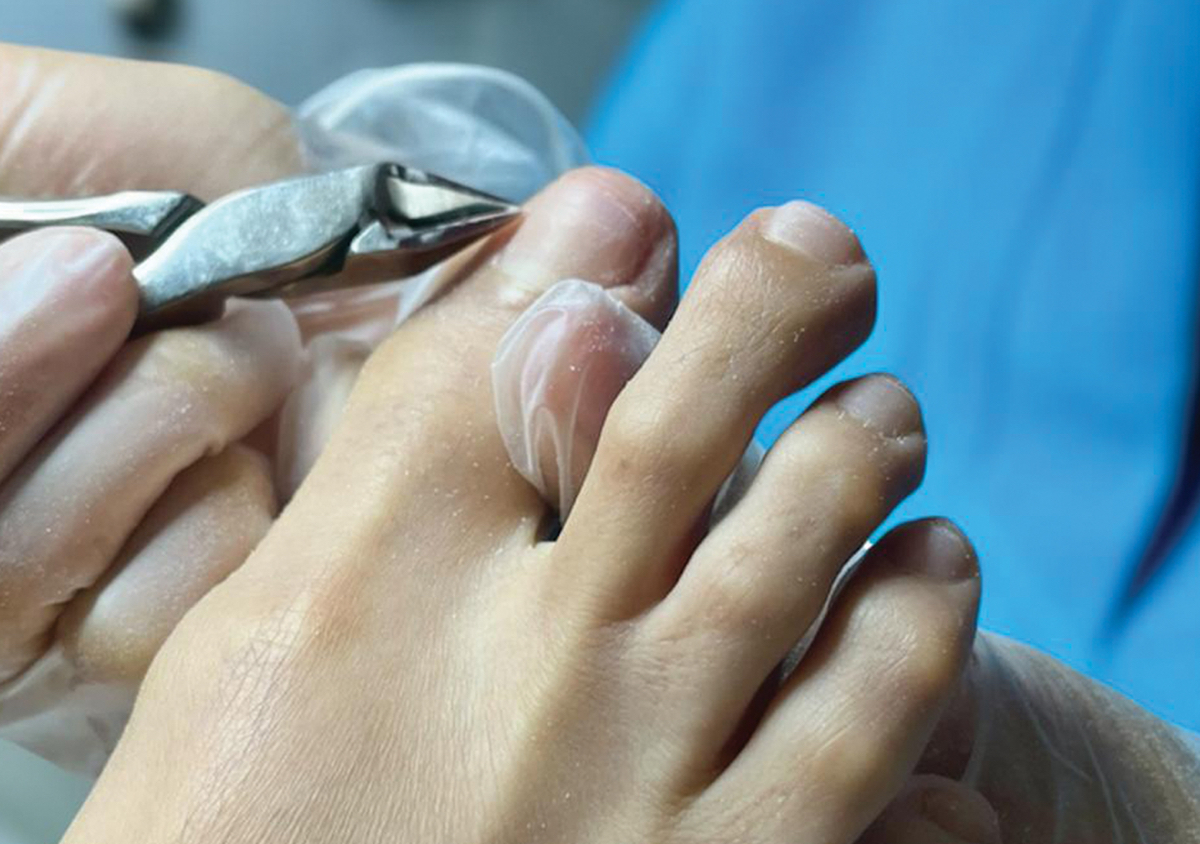 Pedicura pie diabético 