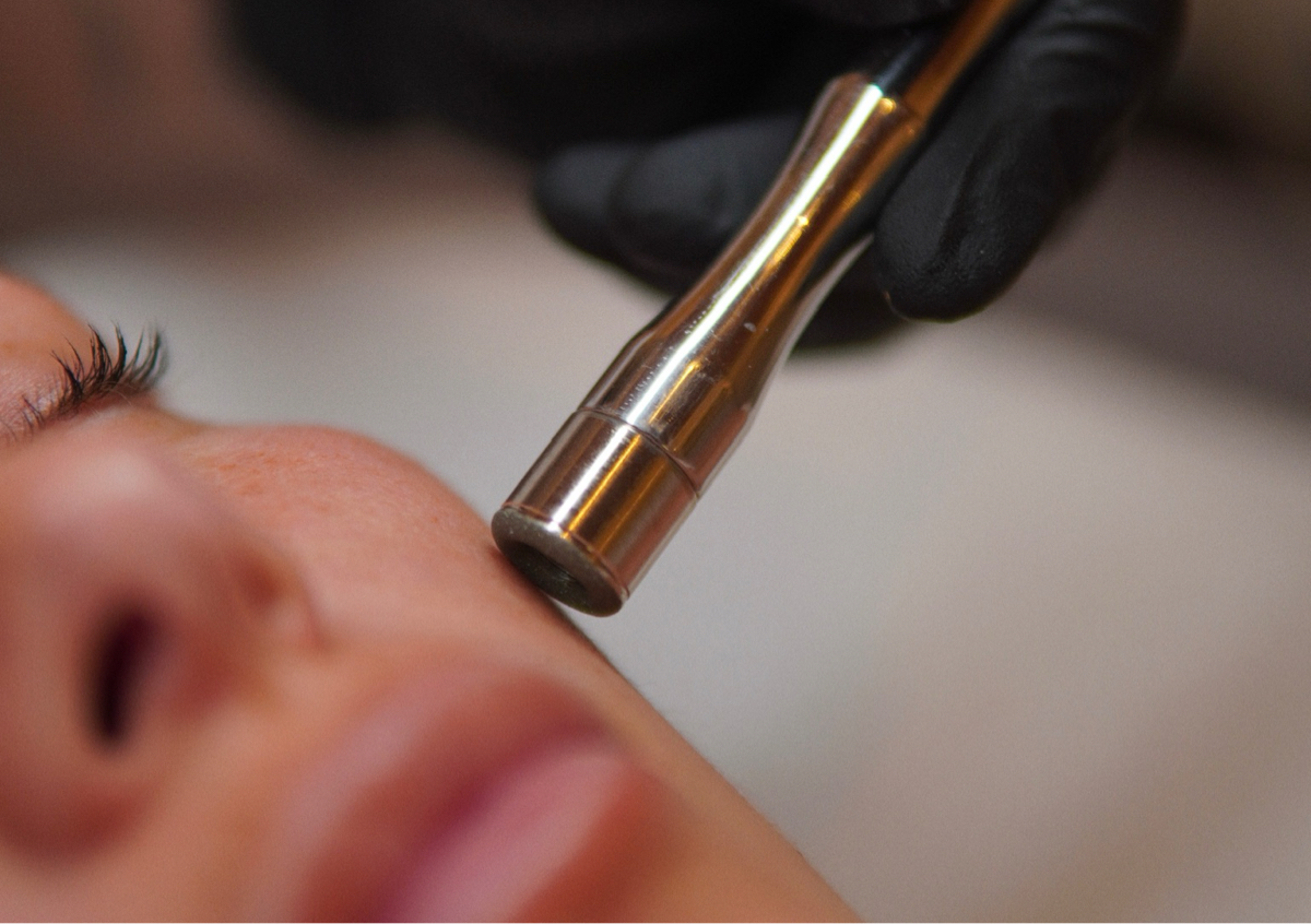 Microdermabrasion 