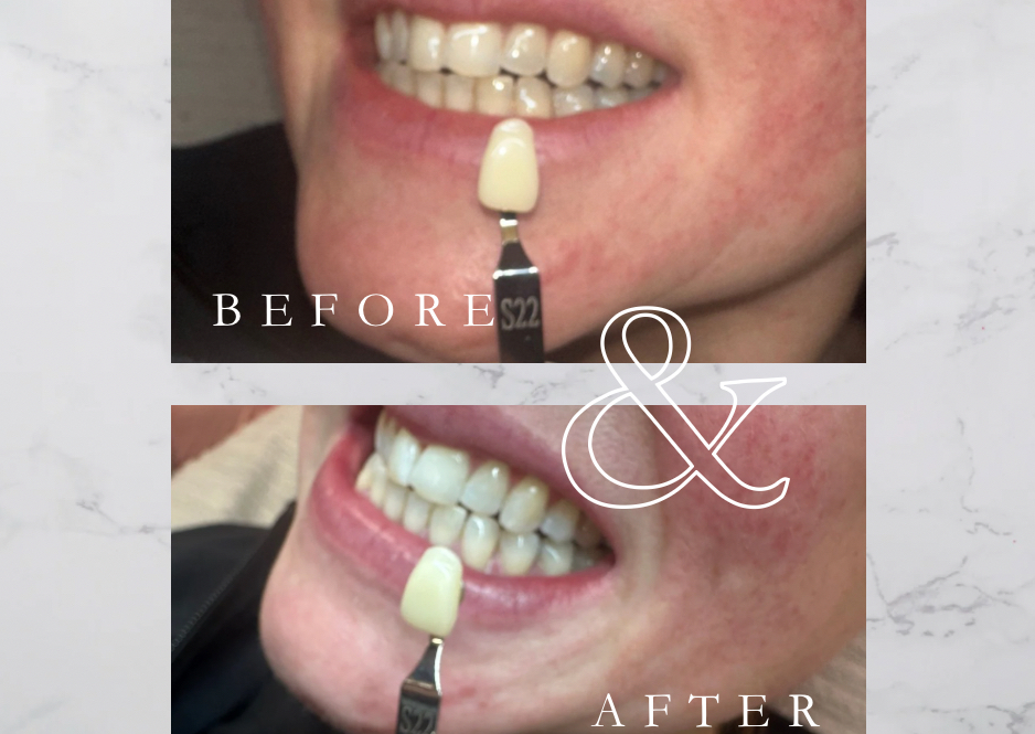 Teeth whitening 45 minutes