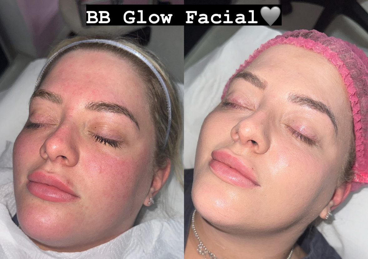 BB Glow Facial 