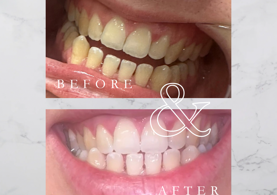 Teeth whitening 60 minutes