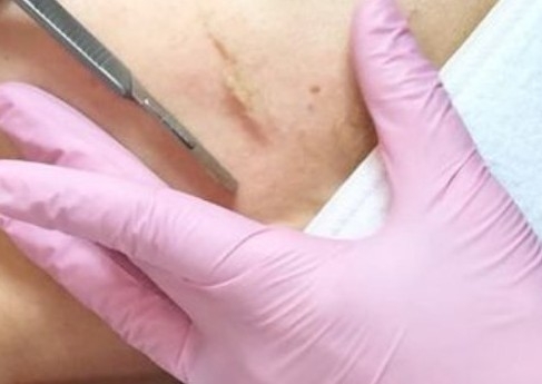Dermaplaining facial