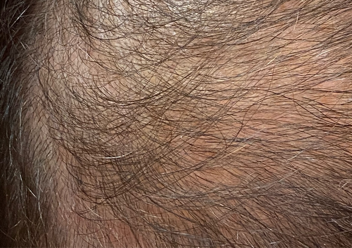 Hair loss treatments 