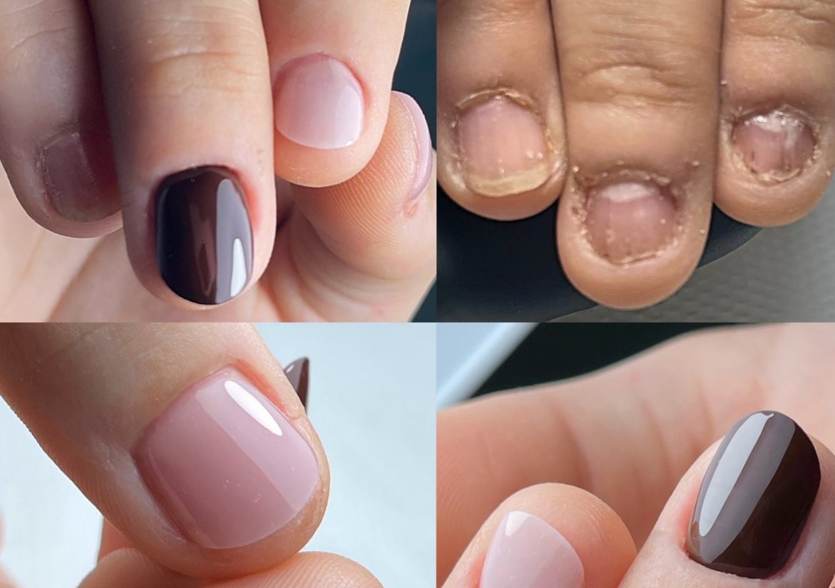 Ricostruzione onicofagica 