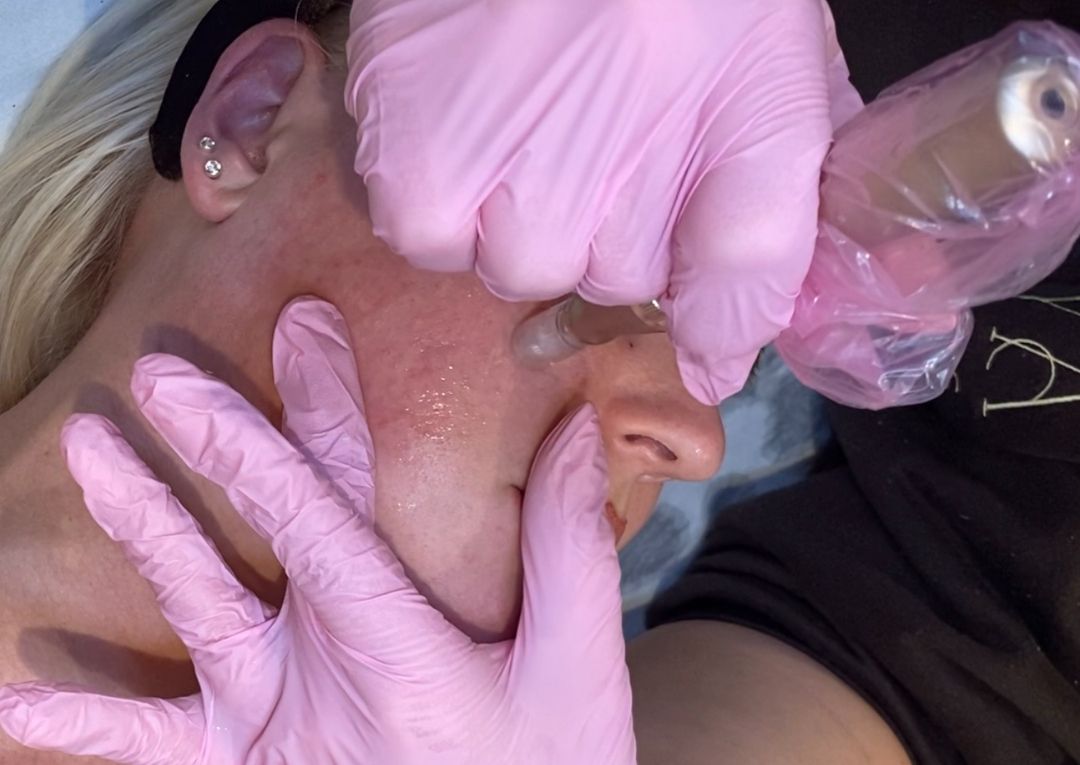 x 3 Micro-Needling Facials