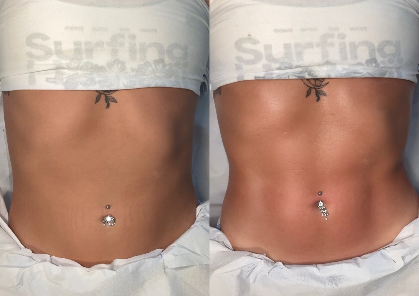 Tummy wood therapy & BLDM