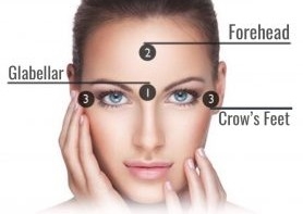 Botox 3 areas