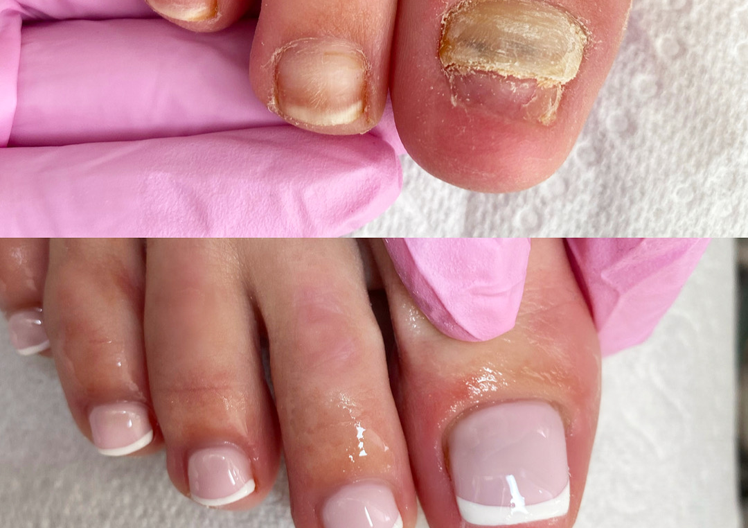 Toe reconstruction plus gel finish
