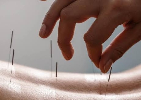 Massage and Acupuncture ~ 1 Hour and 40 Mins