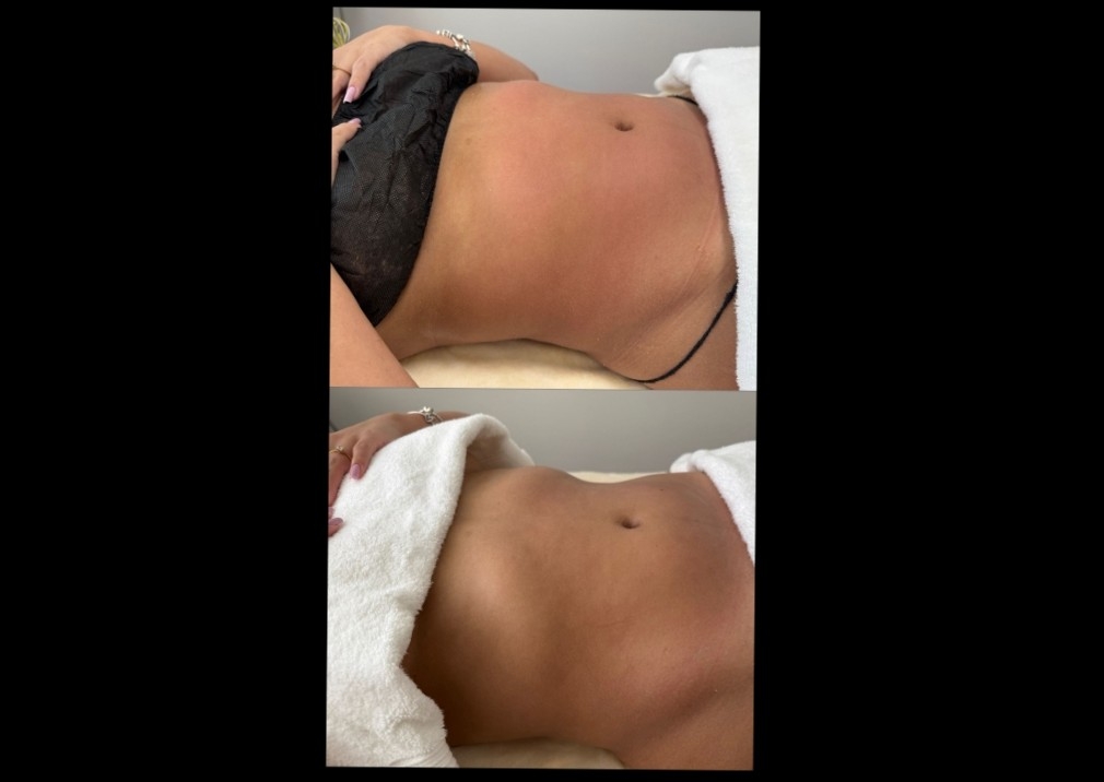 Lymphatic Drainage
Single session: US$ 95