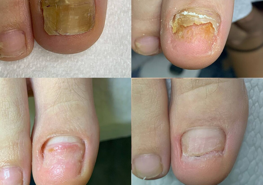 Onicoliza +Protezare