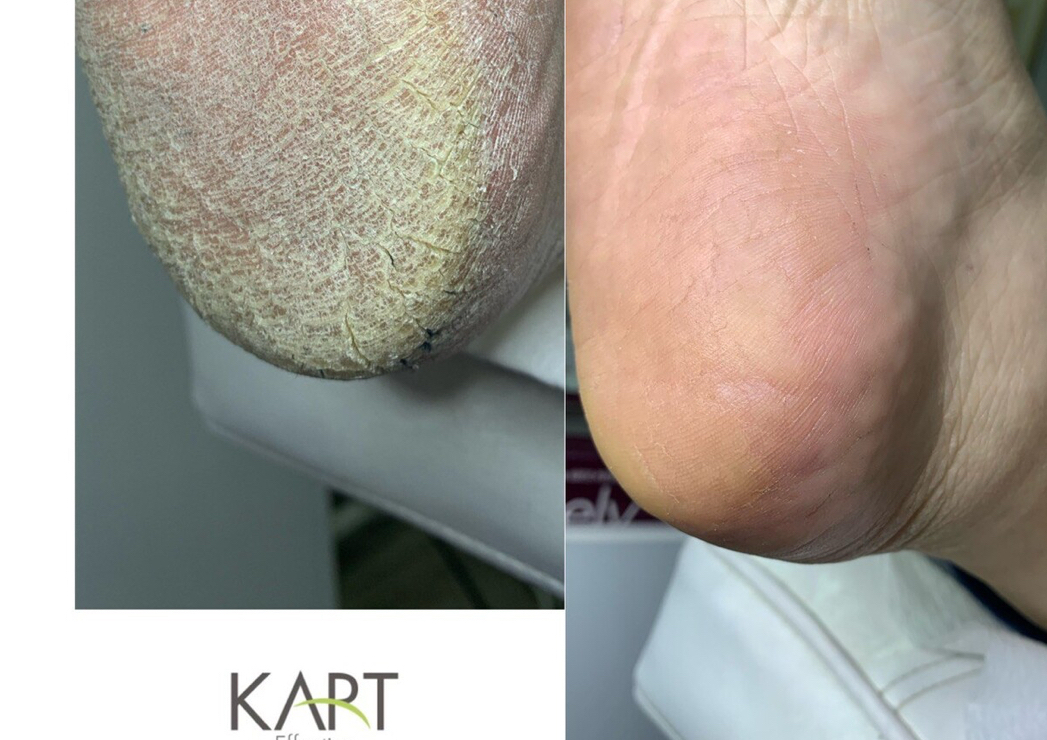 Talpa problematica ( calus ingrosat)