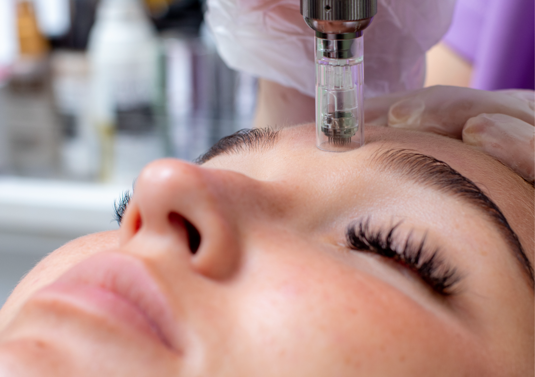 Digital Microneedling with Imedpen Pen to Face & Neck 