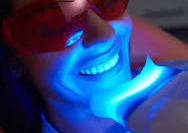 teeth  whitening one session