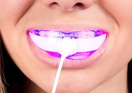 Teeth whitening add-on