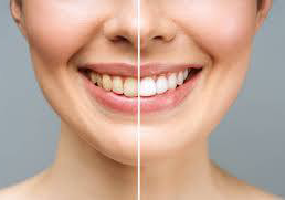 Teeth whitening 2 sessions 