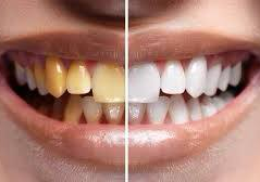Chair-side Teeth Whitening add on