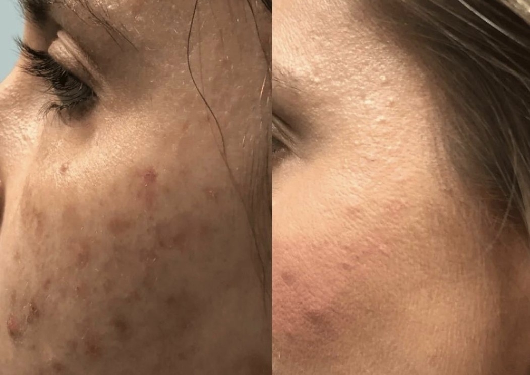 Full Face Rejuvenation