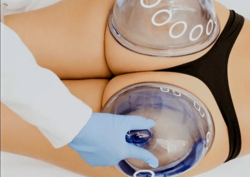 Butt Lift Vacuum Therapy Session