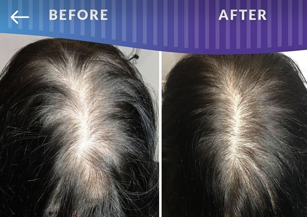 Procell Hair Microchanneling Session