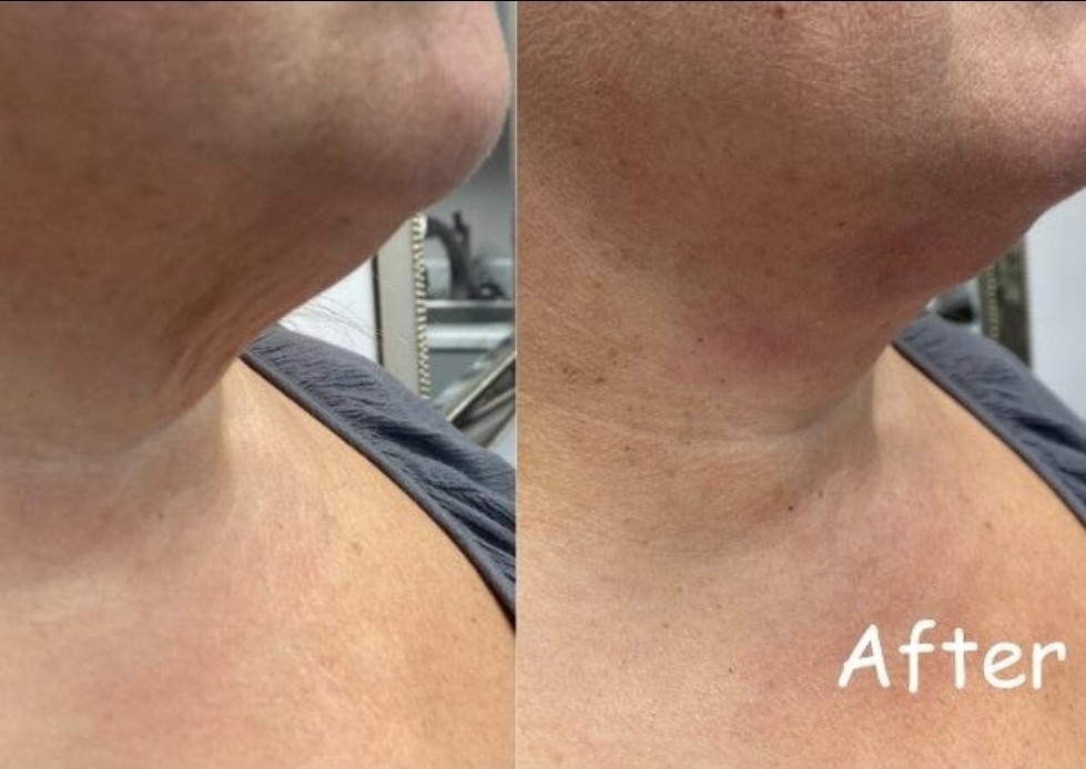 Full Face Rejuvenation Packagesĺ