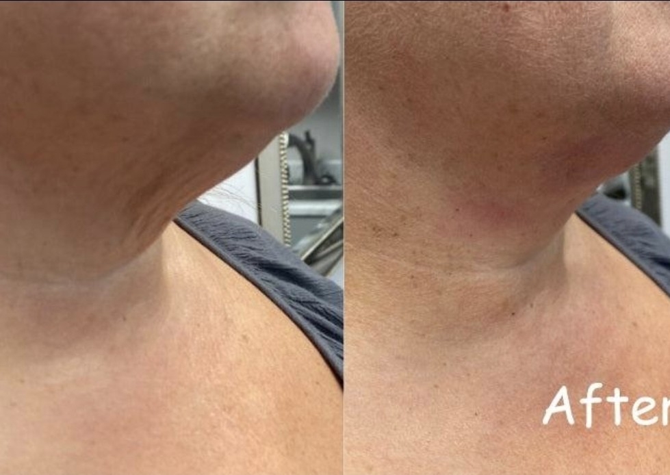 Neck Renewal Treatment Packages