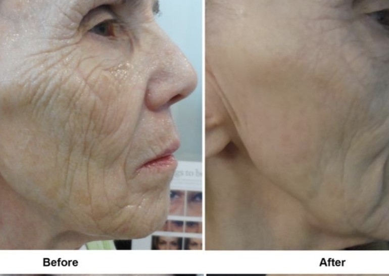 Neck Renewal Treatment