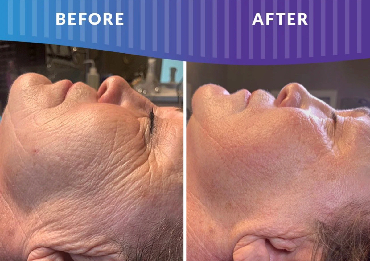 Microchanneling Facial (3 Sessions)