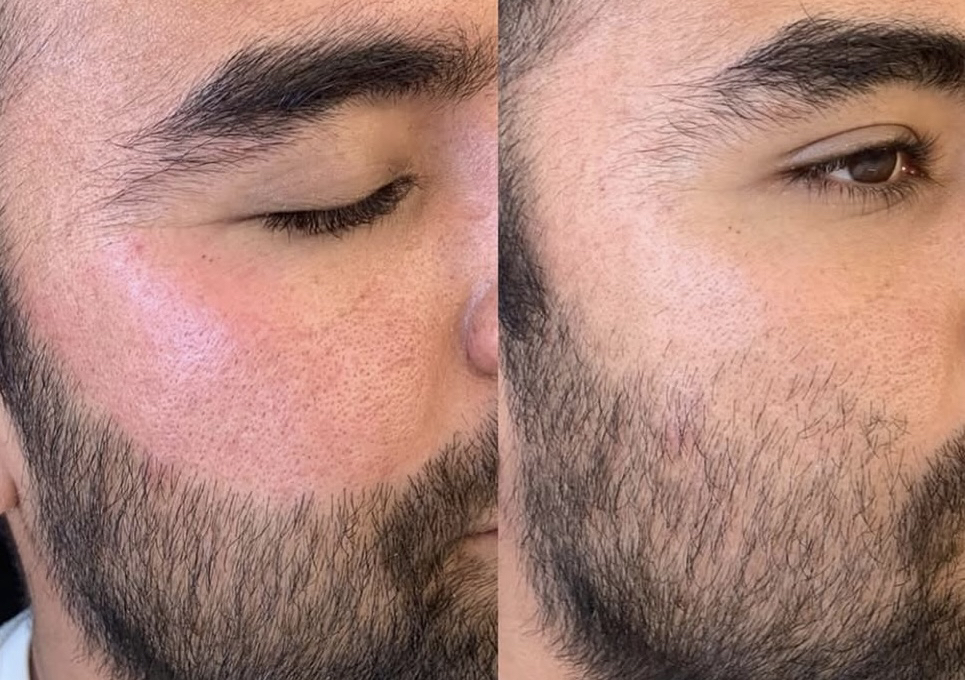 Sideburns(women) or beard line (men) Threading 