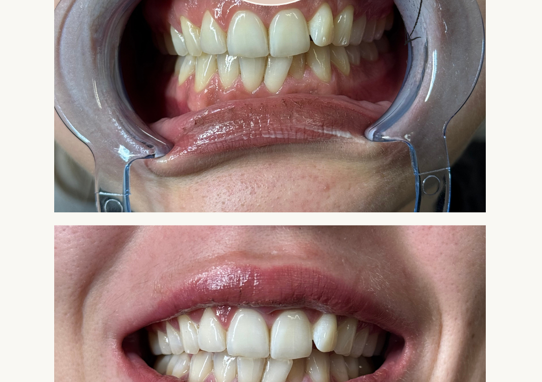 Blanchiment americain 