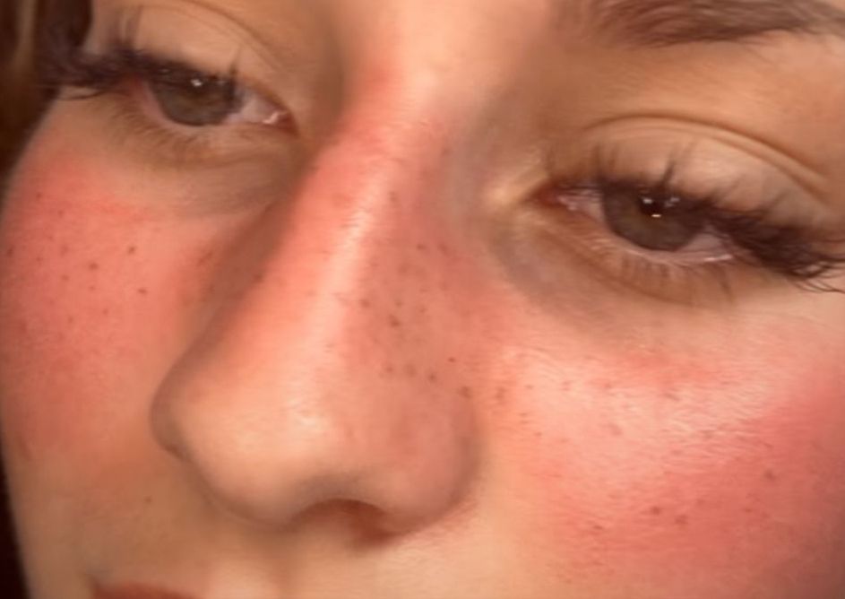 Tâches de rousseurs