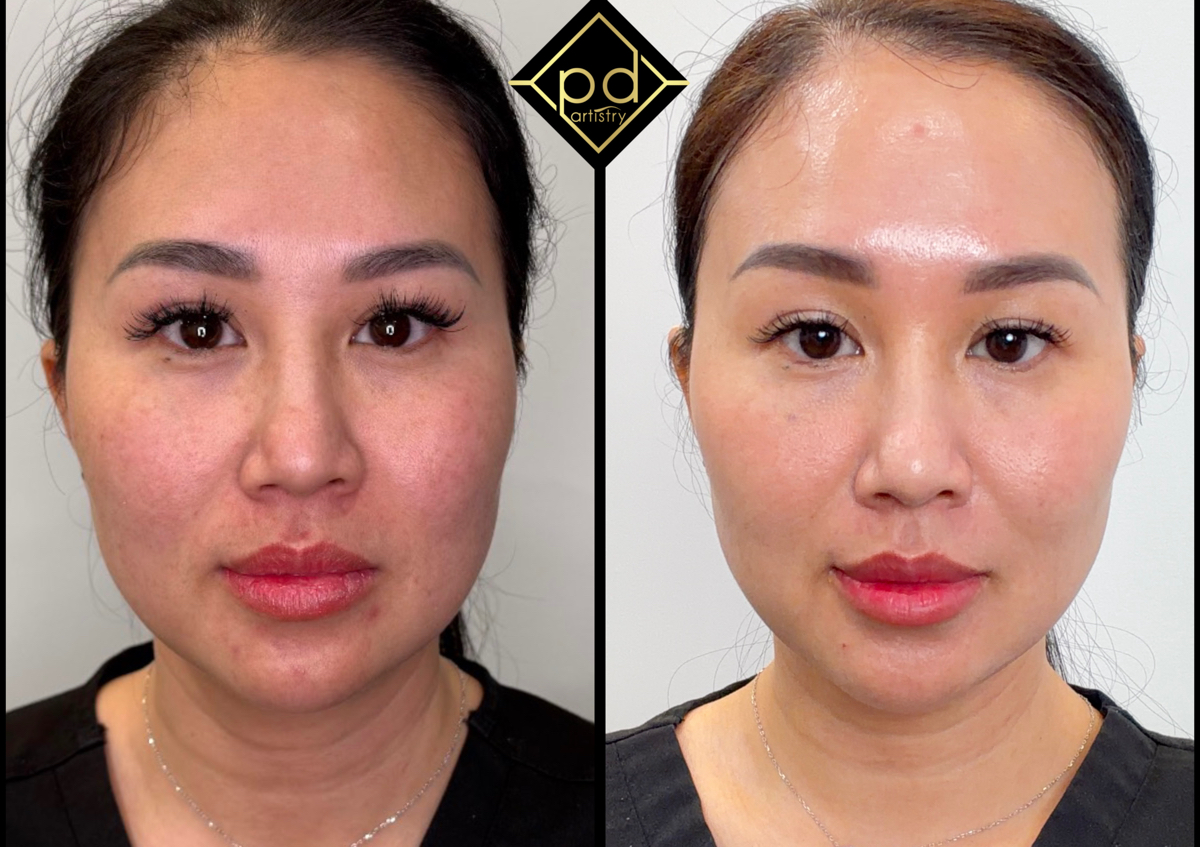 Full Face Rejuvenation  (2/4)