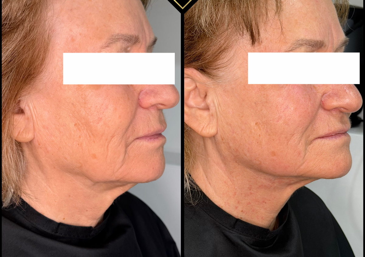 Full Face Rejuvenation  (4/4)