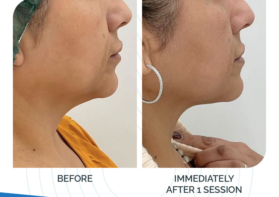 Half Face Rejuvenation 