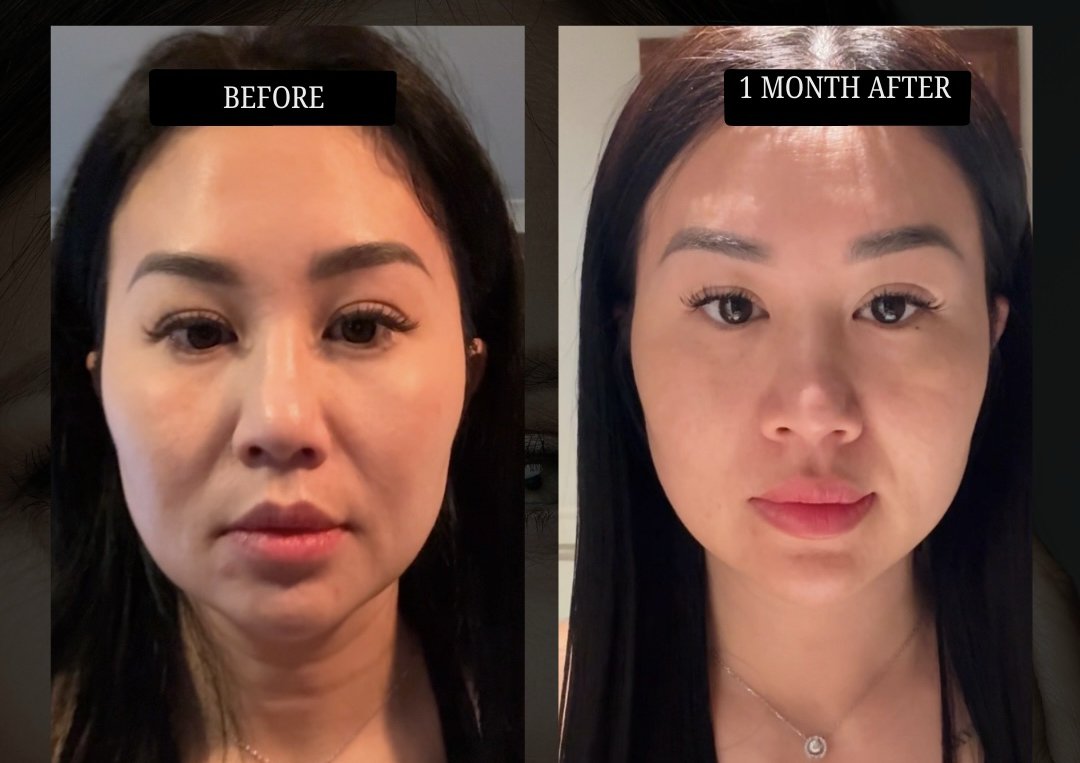 Consultation - For CFU 