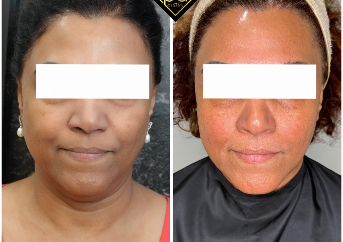 Full Face Rejuvenation  (3/4)