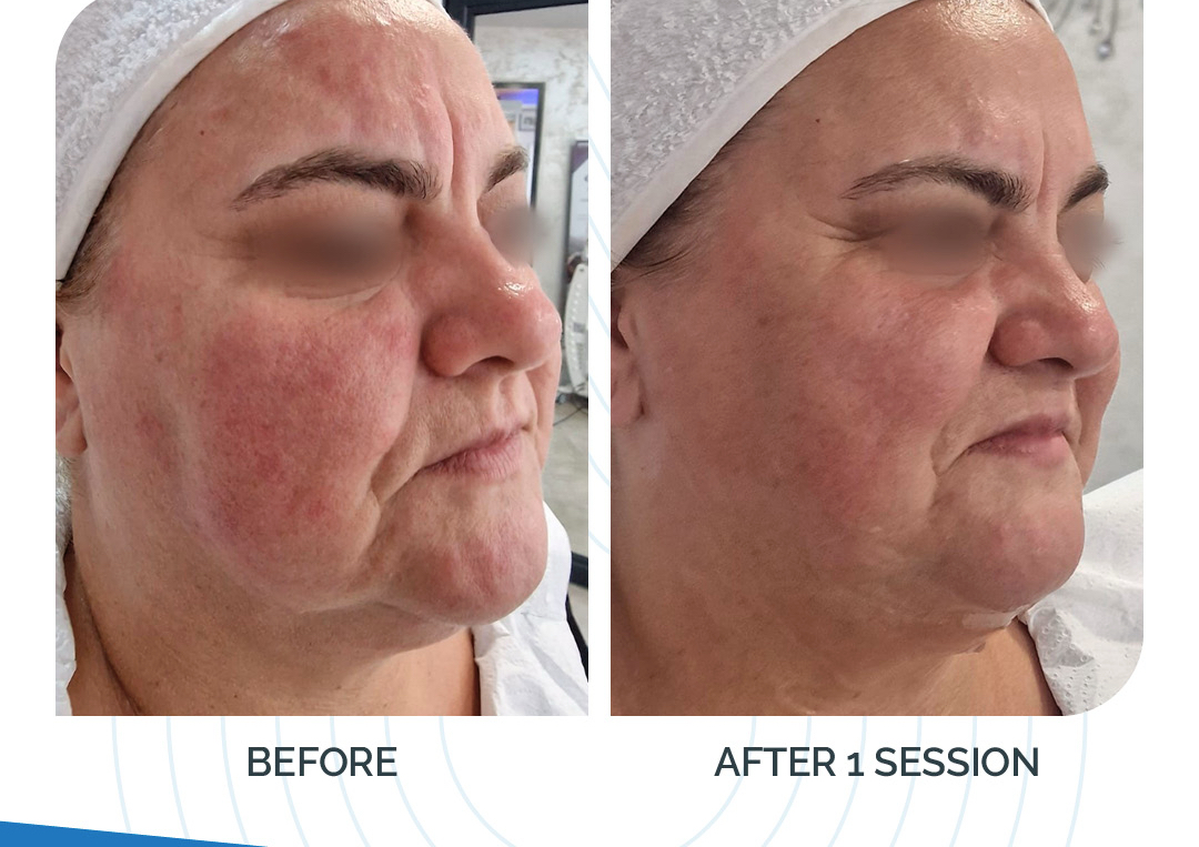 Full Face Rejuvenation 