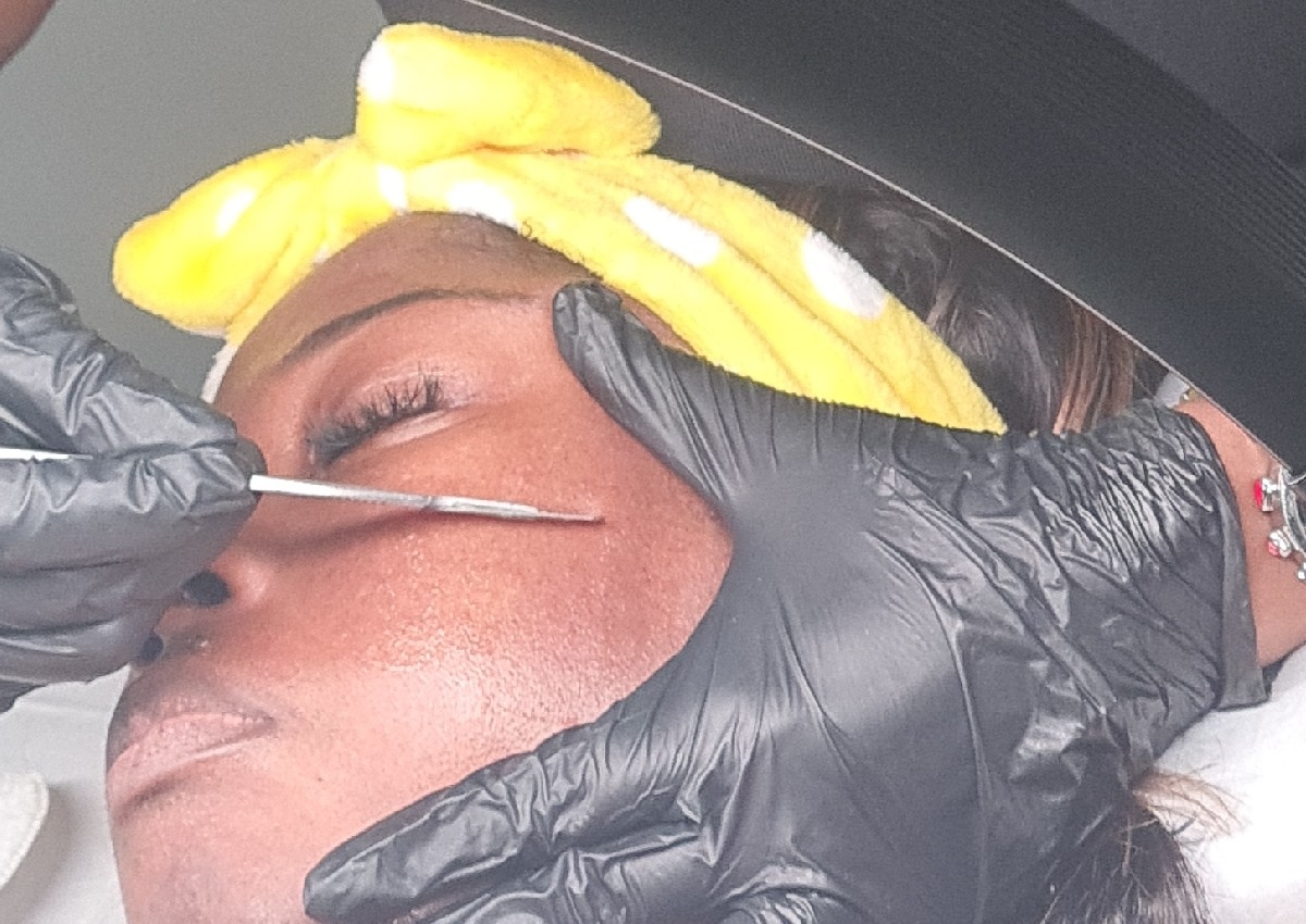 Dermaplaning