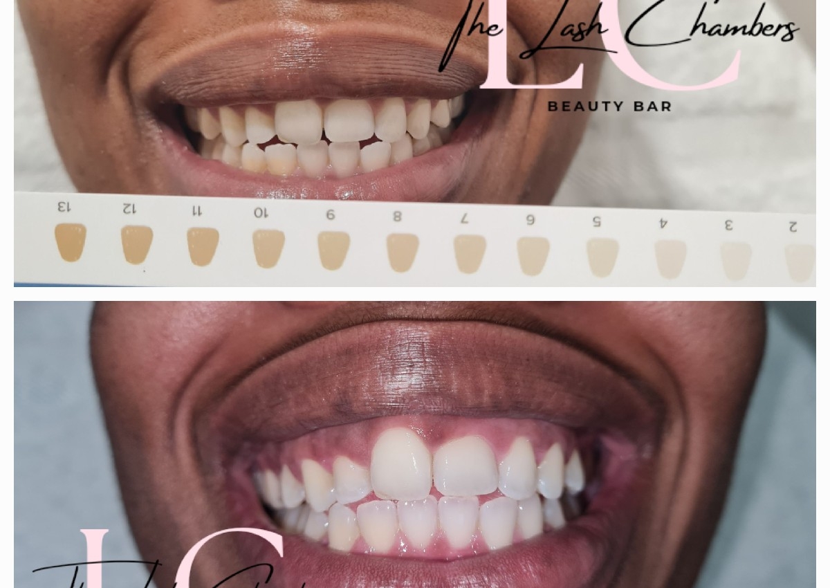 Teeth whitening 40 mins