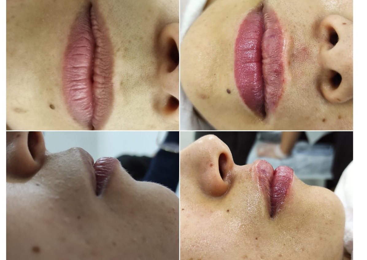 Harmonização labial