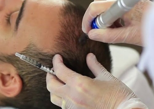 Regeneração capilar micro-agulhamento 