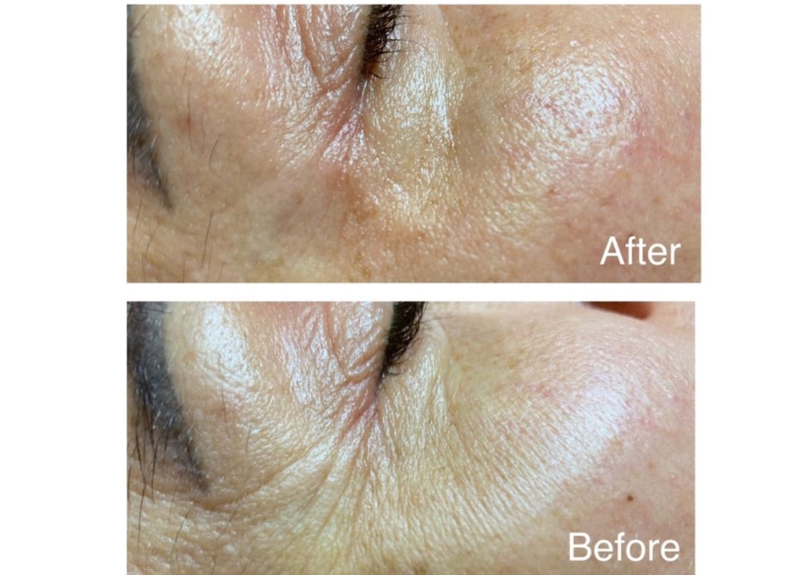 Smart Plasma Collagen Lifting- 3 Treatments