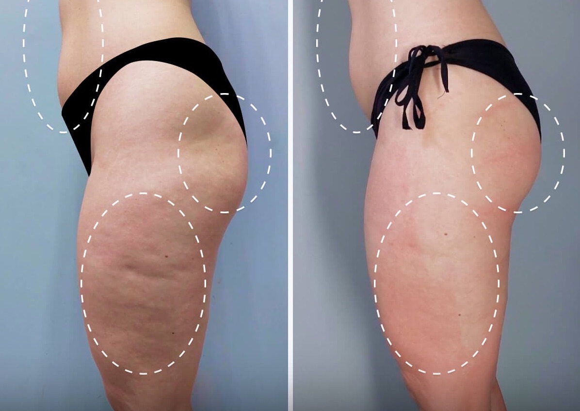 Bionexis 3 Cellulite Treatment Back side