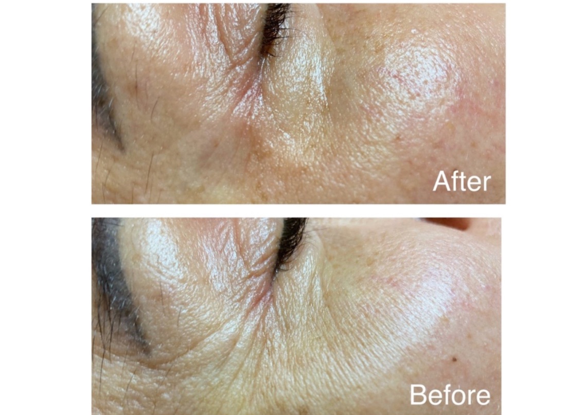 Smart Plasma Collagen Lifting